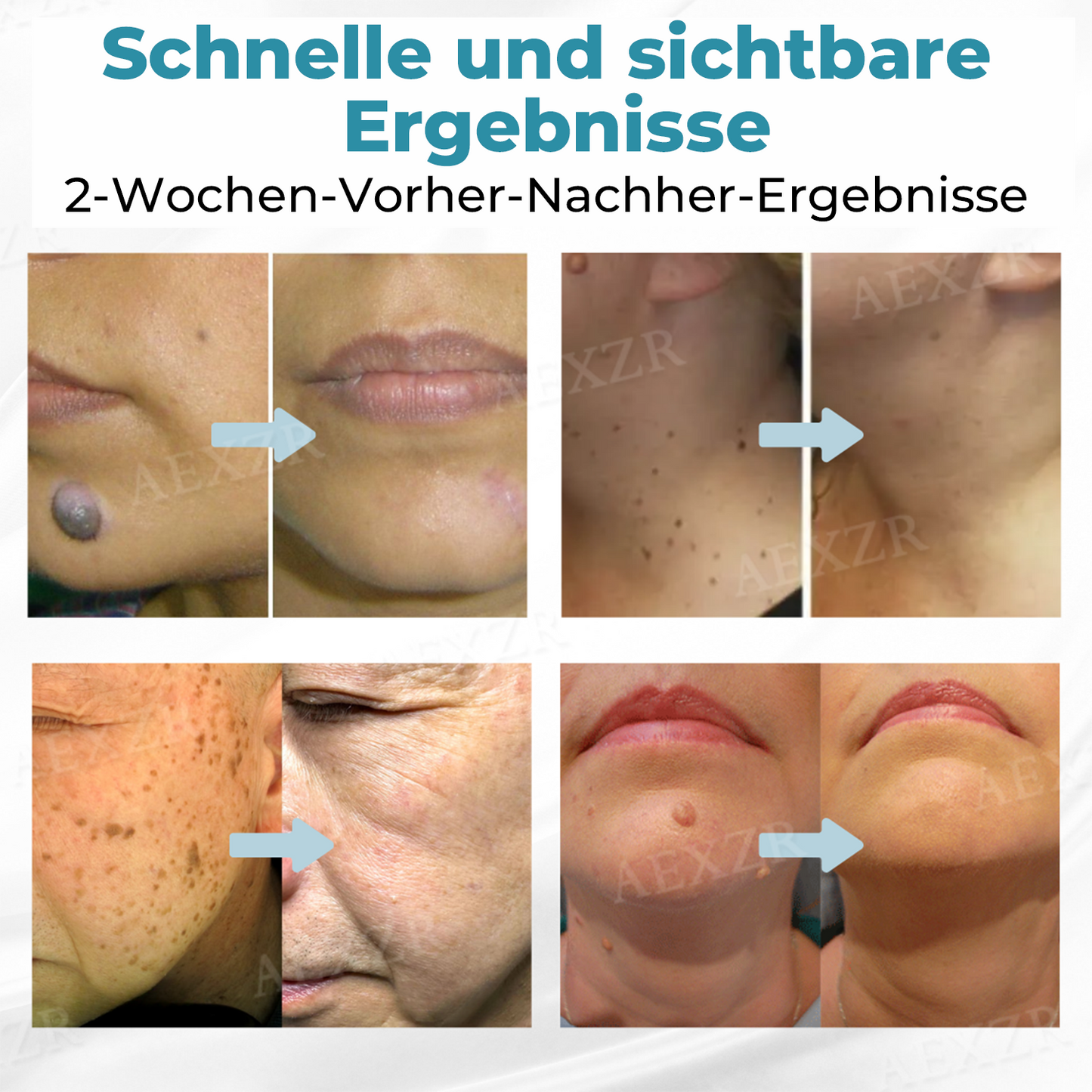 ✨Nurbini® Nicht-invasiver Laser-Stift zur Entfernung von Muttermalen und Warzen✨
