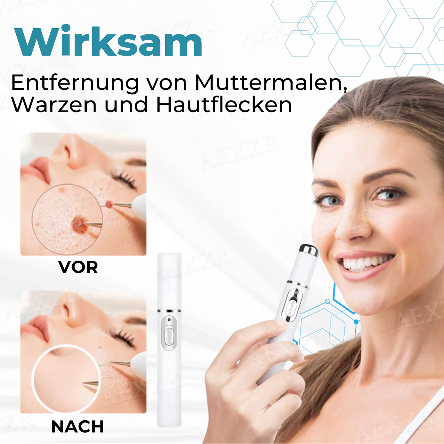 ✨Nurbini® Nicht-invasiver Laser-Stift zur Entfernung von Muttermalen und Warzen✨